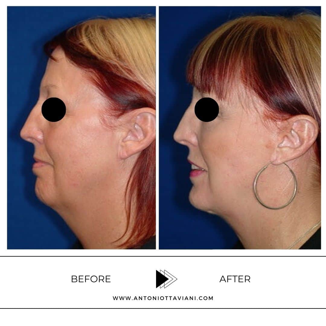 Prima dopo lifting viso - Prof. Antonio Ottaviani, chirurgo plastico Roma, Milano, Torino