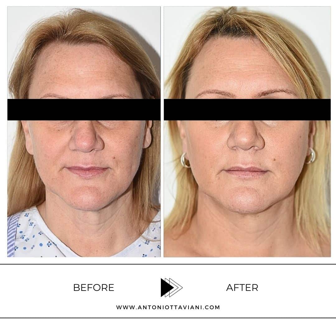 Prima dopo lifting viso - Prof. Antonio Ottaviani, chirurgo plastico Roma, Milano, Torino