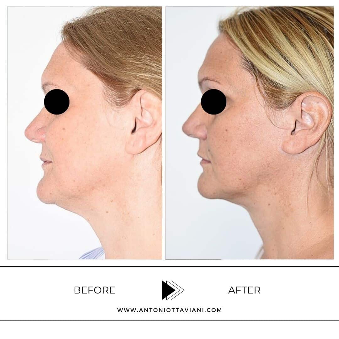 Prima dopo lifting viso - Prof. Antonio Ottaviani, chirurgo plastico Roma, Milano, Torino