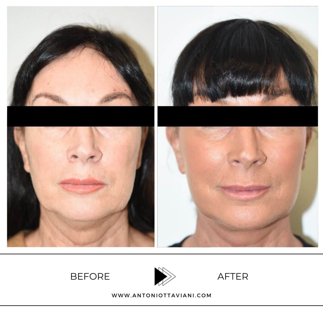 Prima dopo lifting viso - Prof. Antonio Ottaviani, chirurgo plastico Roma, Milano, Torino