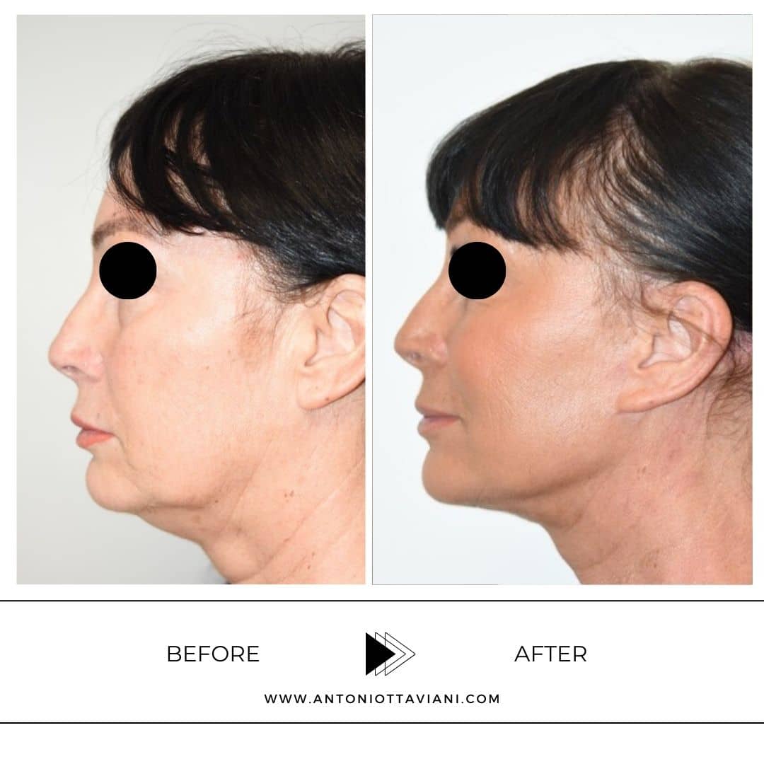 Lifting Viso Foto - Chirurgia Plastica Viso Clinica - Foto 8