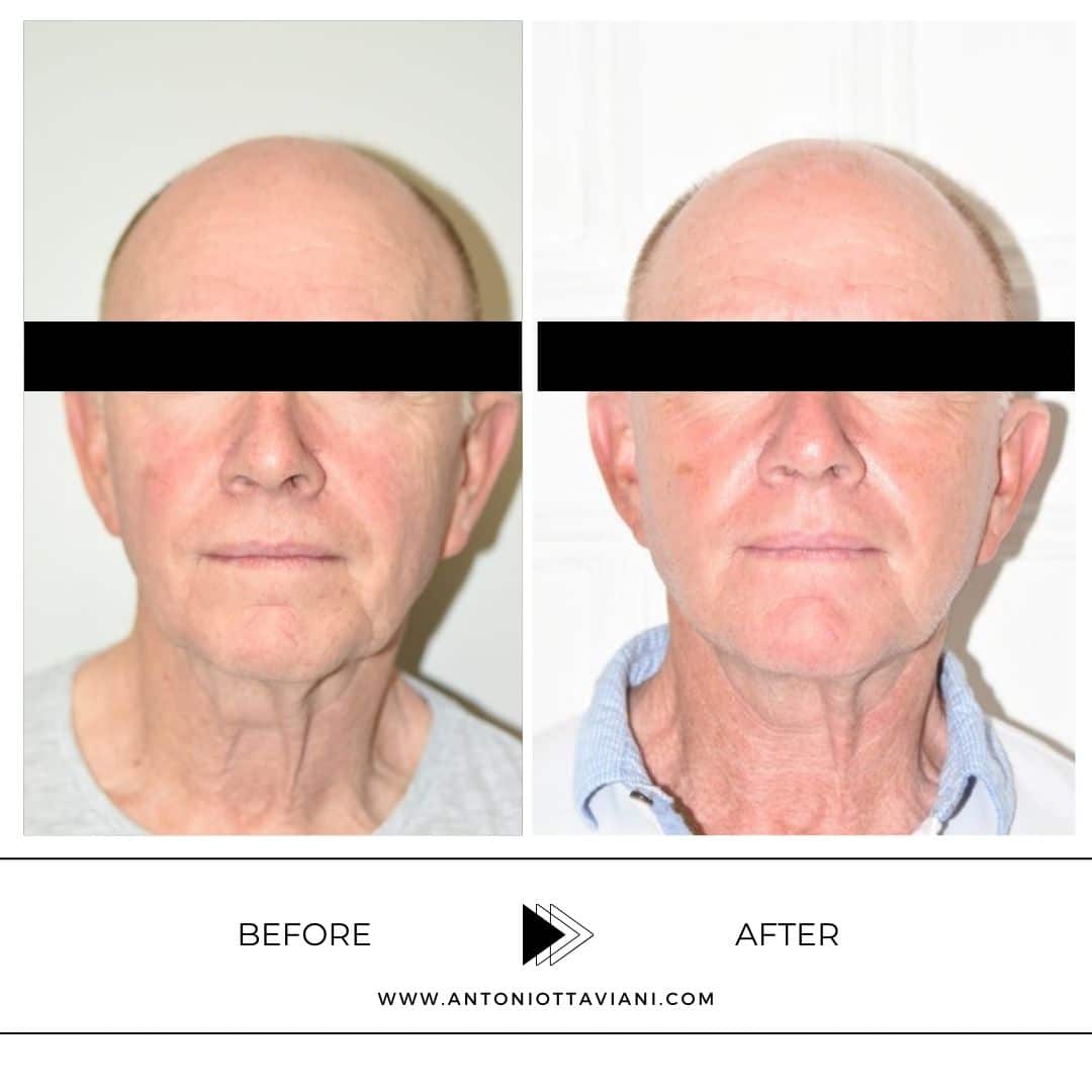 Prima dopo lifting viso - Prof. Antonio Ottaviani, chirurgo plastico Roma, Milano, Torino