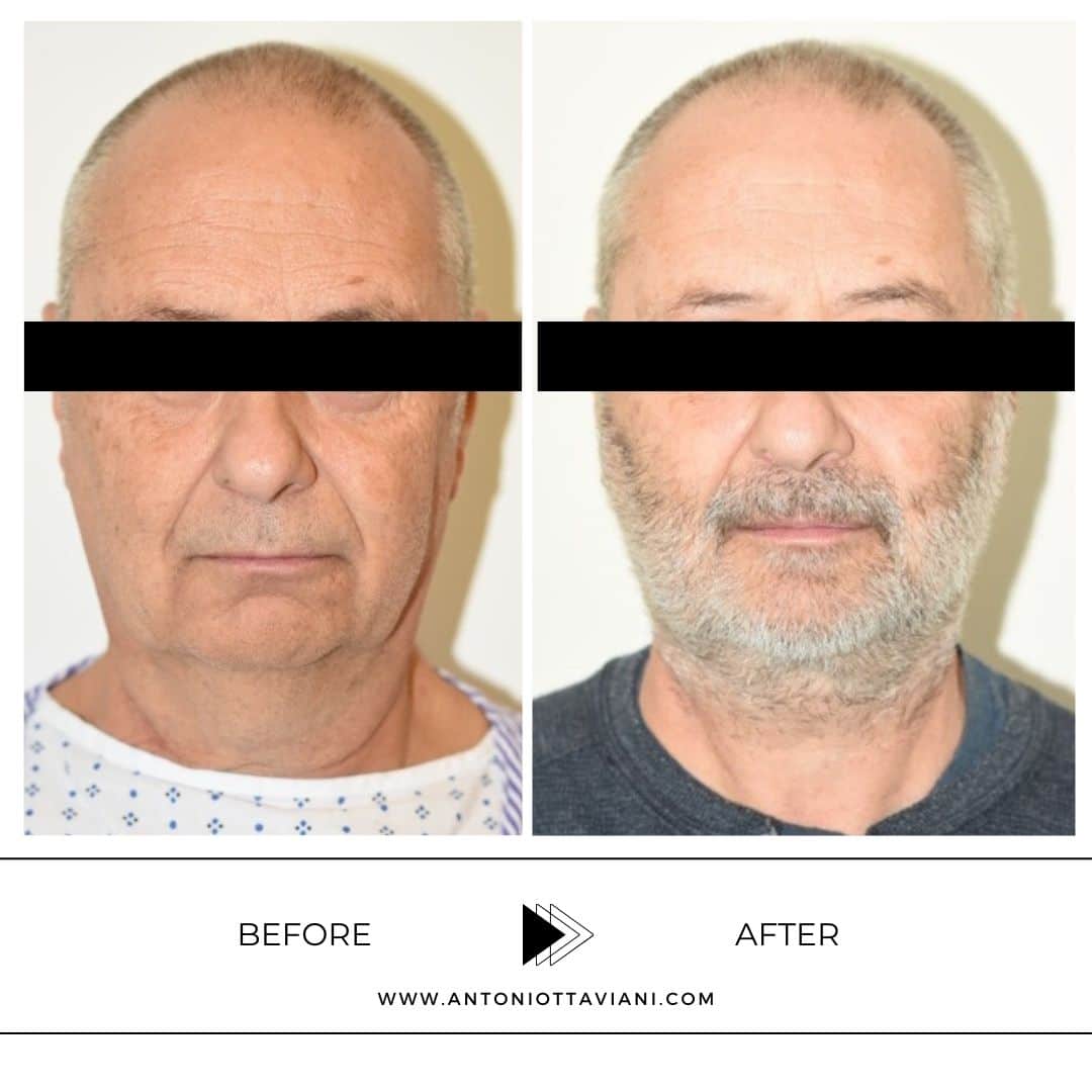 Prima dopo lifting viso - Prof. Antonio Ottaviani, chirurgo plastico Roma, Milano, Torino