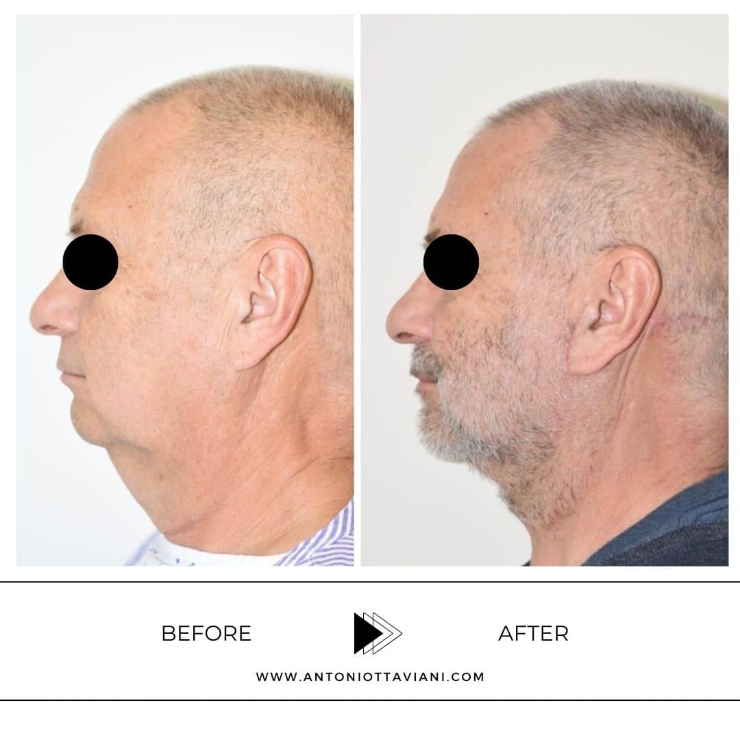 Prima dopo lifting viso - Prof. Antonio Ottaviani, chirurgo plastico Roma, Milano, Torino