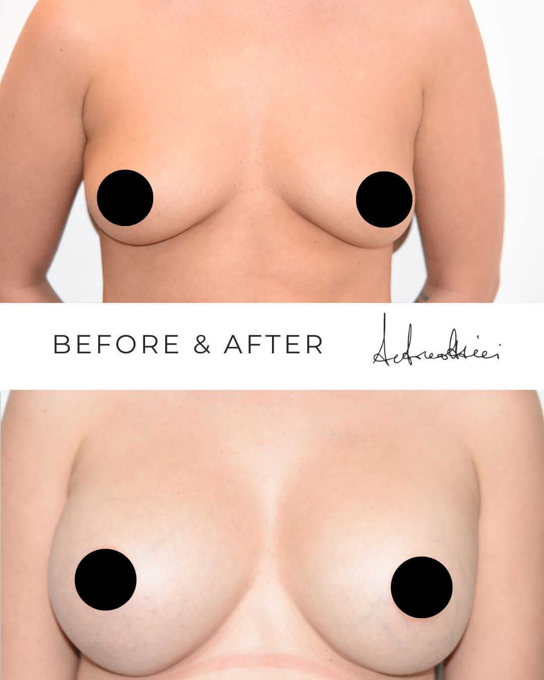 Mastoplastica additiva - prima/dopo - Prof. Antonio Ottaviani - Chirurgo Plastico Roma